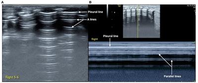 Case Report: Neonatal Massive Pneumothorax Resulting in <mark class="highlighted">Compression Atelectasis</mark> Treated by Ultrasound-Guided Pleural Puncture Therapy: A Typical Case Based on Lung Ultrasound Finding
